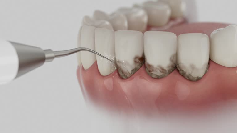 Trusted Dental Implants service in Upper Grand Lagoon, FL - Dentist Open Now